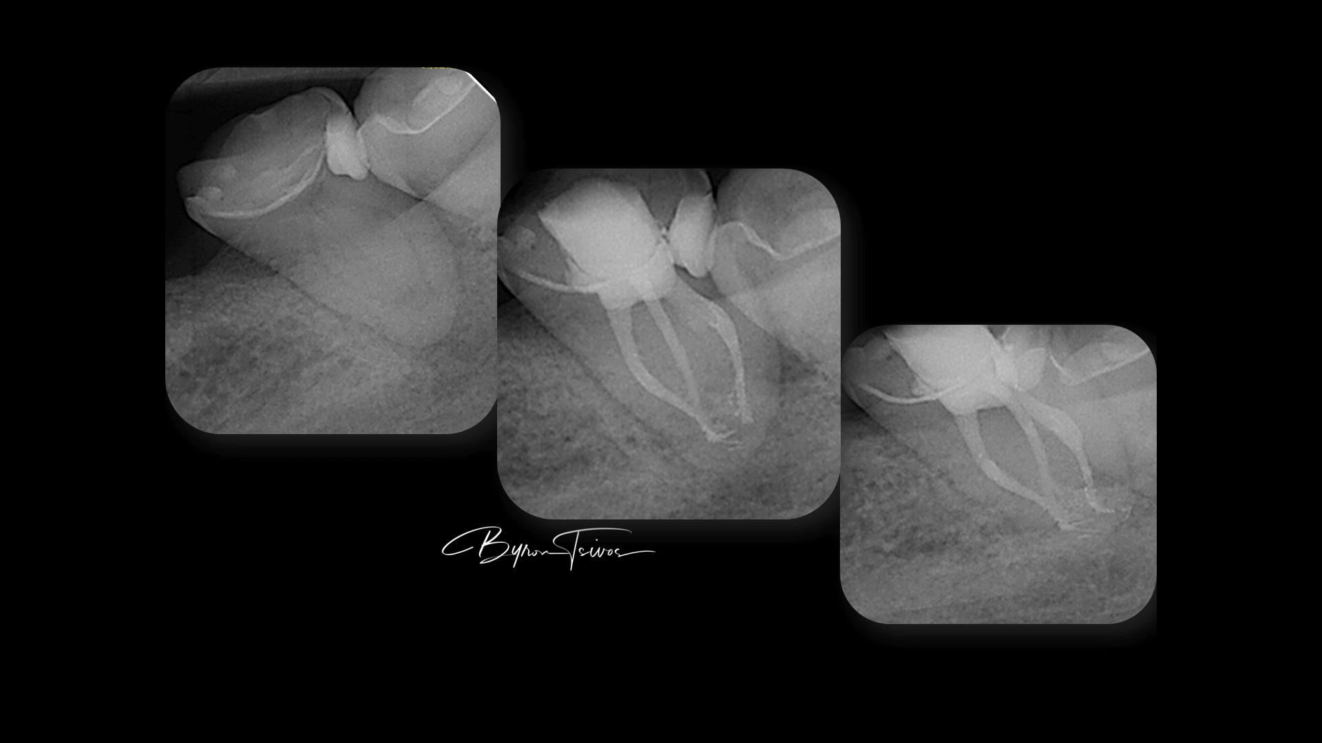 Broken Instrument Removal - Case 6